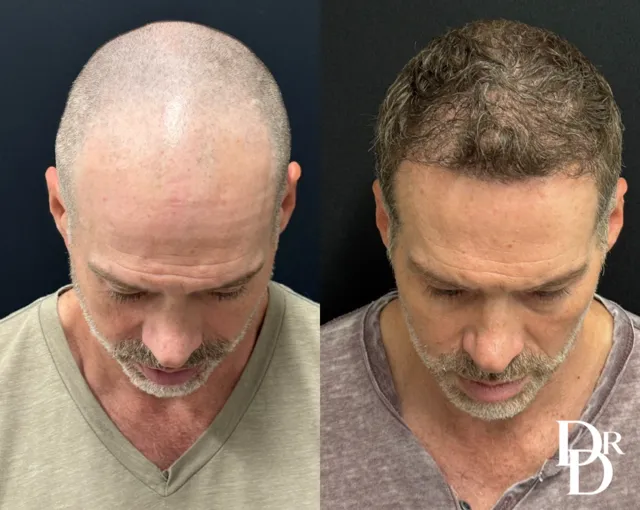 Front View Hair Transplant Before And After Photos By Dr. Demetri