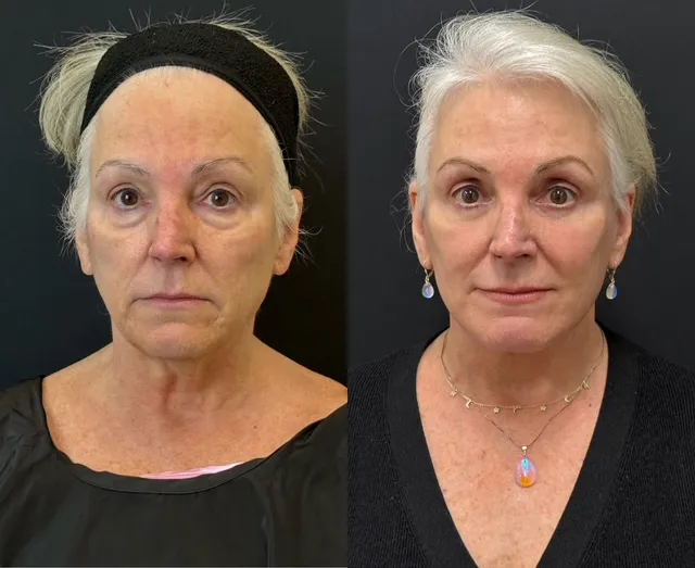 Front View Facelift And Neck Lift Before And After Photos By Dr. Demetri