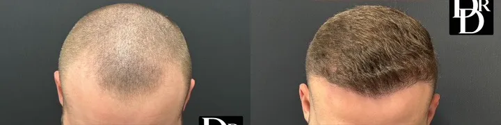 Hair Transplant Before And After Photo By Dr. Demetri