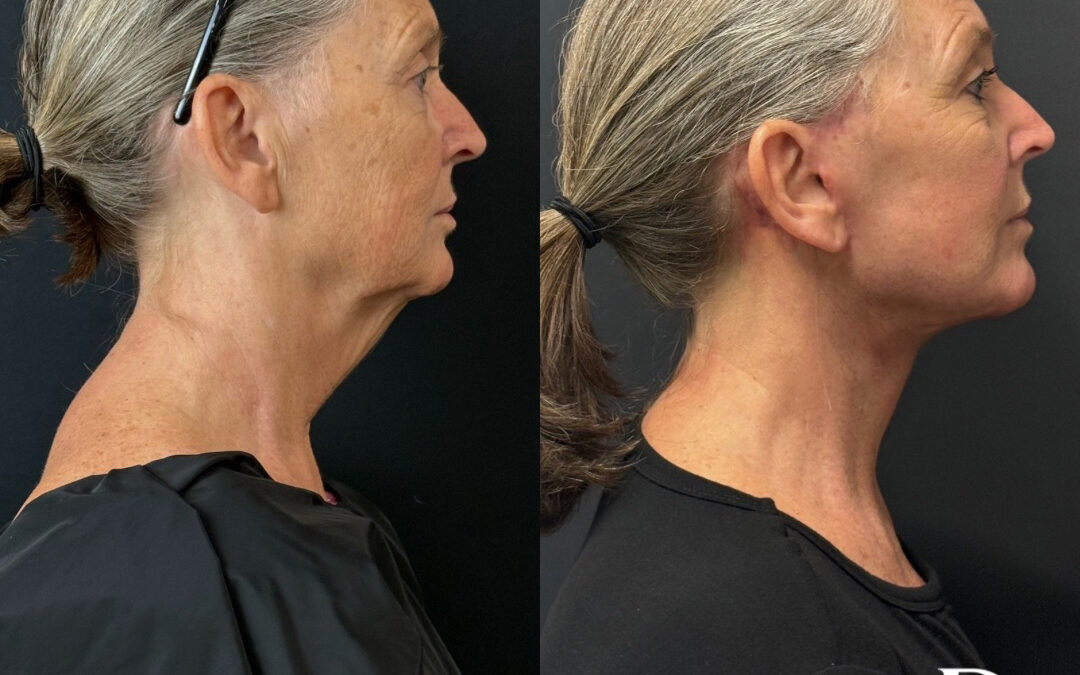 Right Side View Facelift Before And After Photos By Dr. Demetri