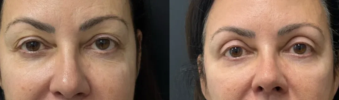 Front View Upper Blepharoplasty Before And After Photos By Dr. Demetri