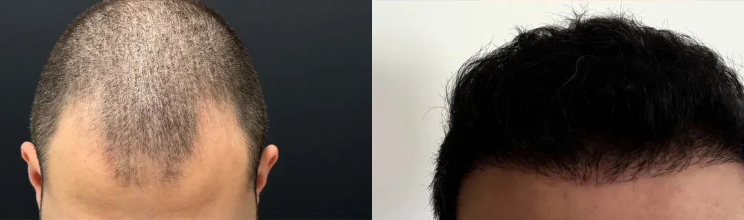 Hair Transplant Before And After Photo By Dr. Demetri