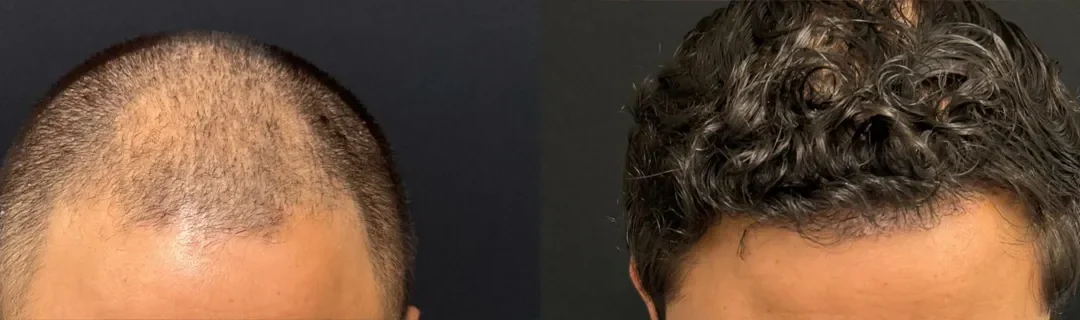 Hair Transplant Before And After Photo By Dr. Demetri