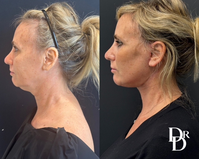 Left Side View Facelift Before And After Photos By Dr. Demetri