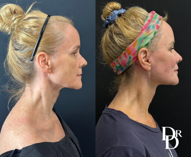 Right Side View Facelift Before And After Photos By Dr. Demetri