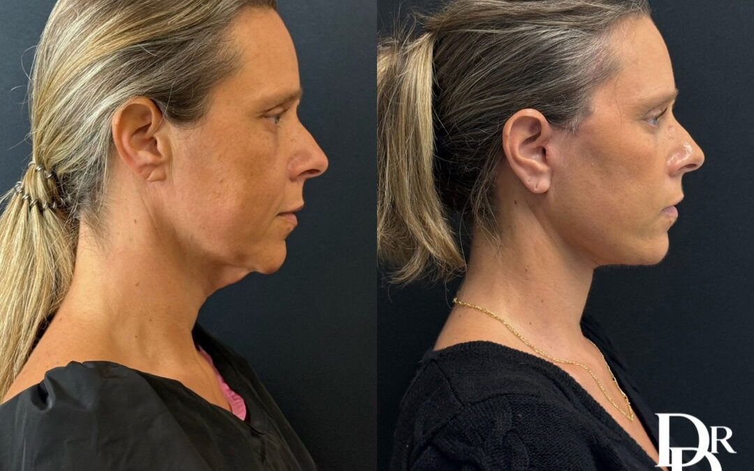 Right Side View Facelift Before And After Photos By Dr. Demetri