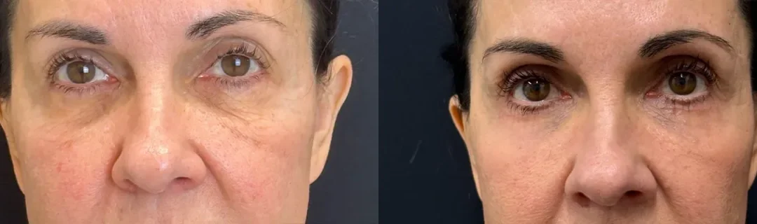 Front View Lower Blepharoplasty Before And After Photos By Dr. Demetri