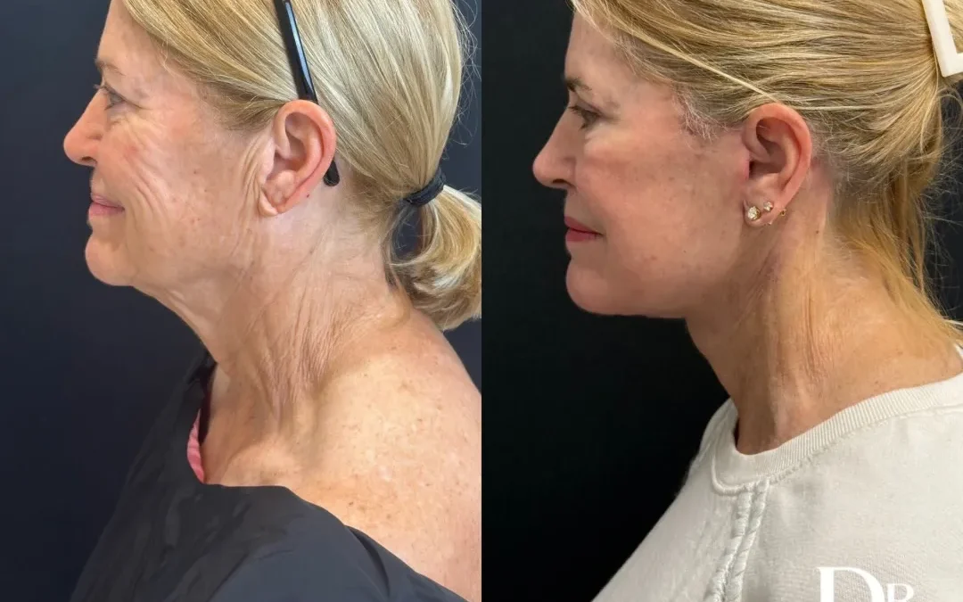 Left Side View Facelift Before And After Photos By Dr. Demetri
