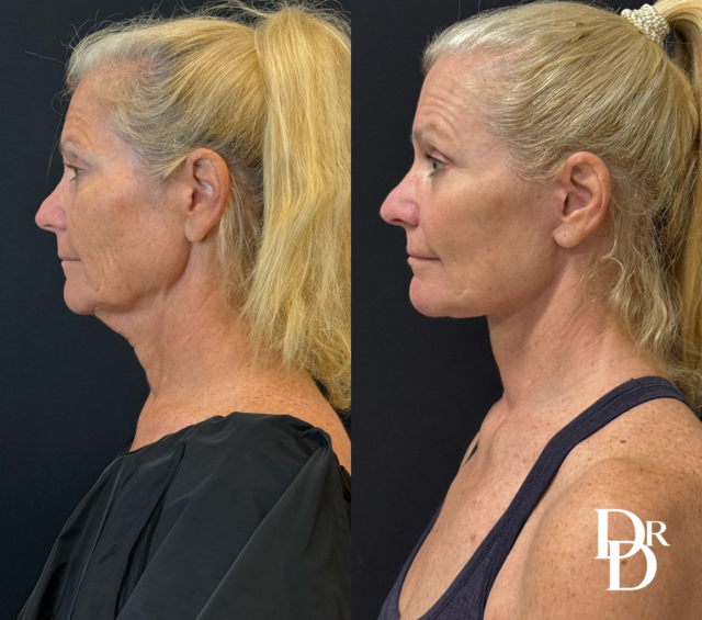 Right Side View Face And Neck Lift Before And After Photos By Dr. Demetri