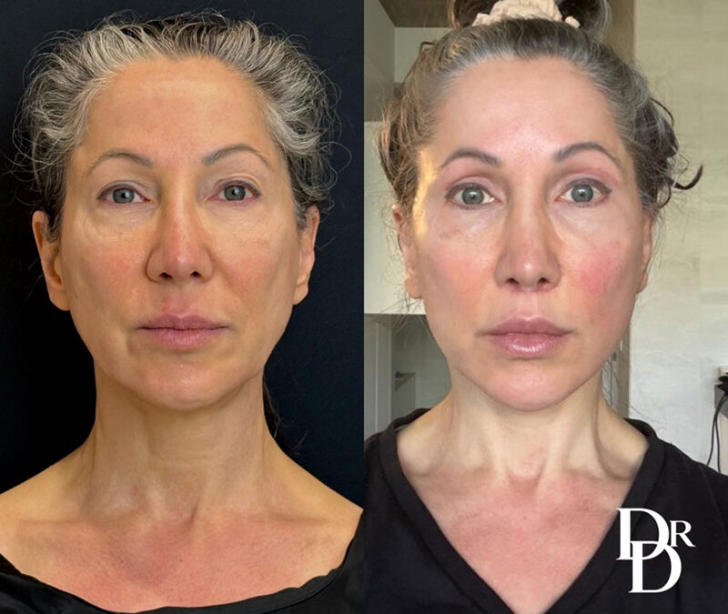 Front View Facelift Before And After Photos By Dr. Demetri