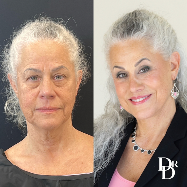 Front View Facelift Before And After Photos By Dr. Demetri