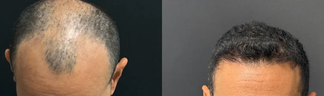 Front View Hair Transpalnt Before And After Photos By Dr. Demetri