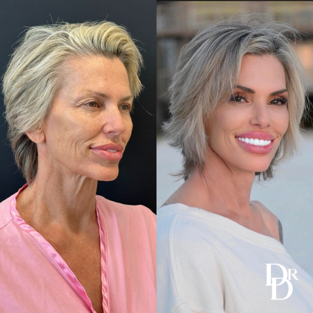 Right Oblique View Facelift Before And After Photos By Dr. Demetri