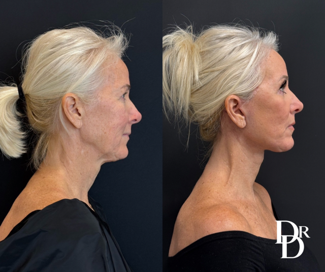 Right Side View Facelift Before And After Photos By Dr. Demetri