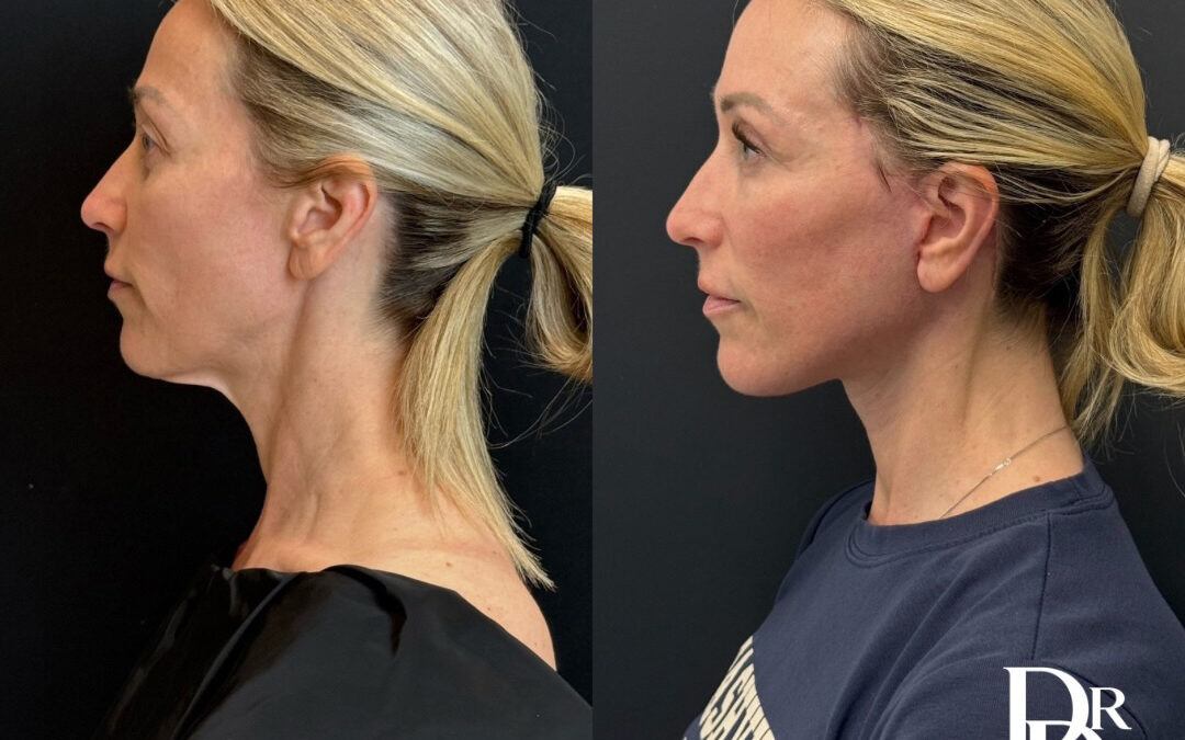 Left Side View Facelift Before And After Photos By Dr. Demetri