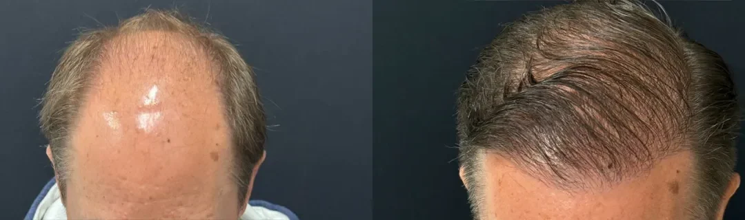 Hair Transplant Before And After Photo By Dr. Demetri