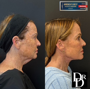 Left Side View Facelift Before And After Photos By Dr. Demetri